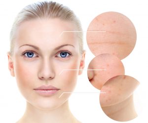 Chemical skin peel