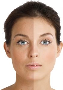 Face chemical skin peel