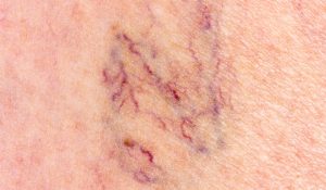 Facial vein treatments