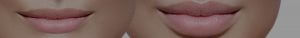 Lip enhancement treatments