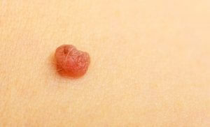 Skin lesion removal