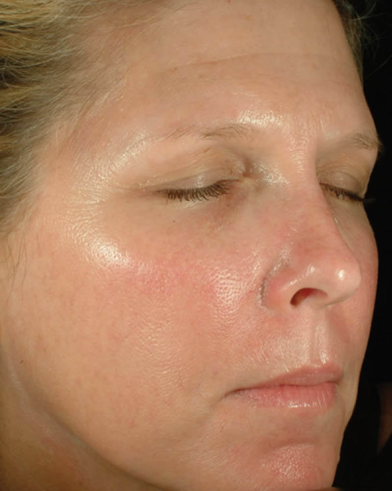 After-Chemical skin peel - before and after