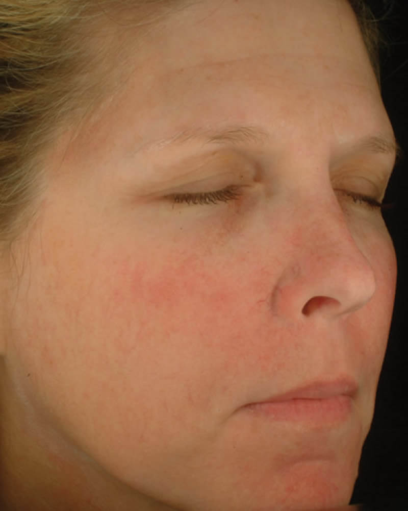 Before-Chemical skin peel - before and after
