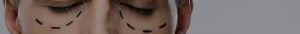 Non surgical blepharoplasty treatments
