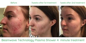 Plasma shower 4 minute treatment of acne