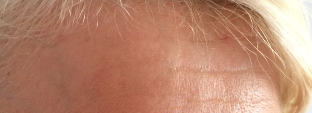 After-Skin Microneedling - Before and after treatment
