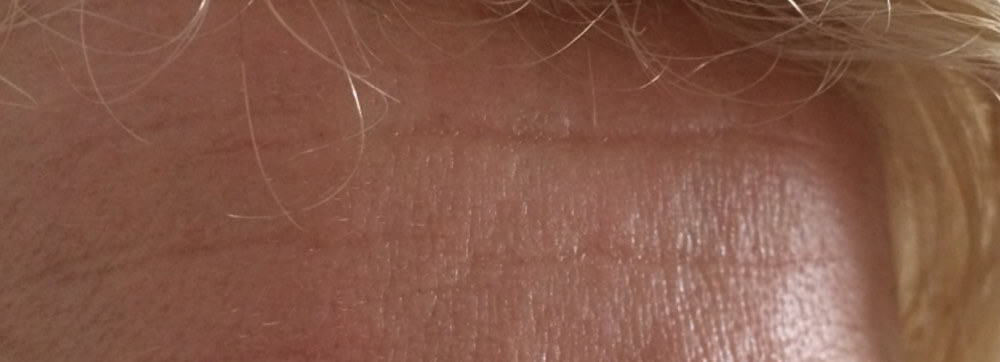 Before-Skin Microneedling - Before and after treatment