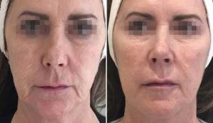 Profilo - face before and after