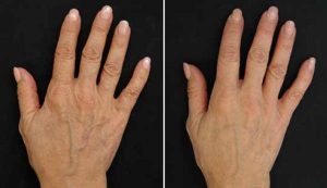 Profilo - hands before and after