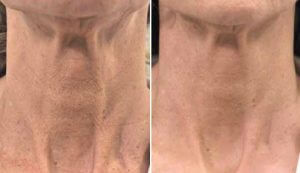 Profilo - neck before and after