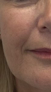 HIFU After treatment