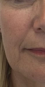 HIFU Before treatment
