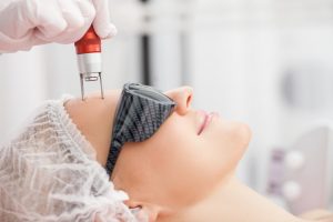 laser hair removal