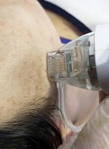 Radiofrequency microneedling